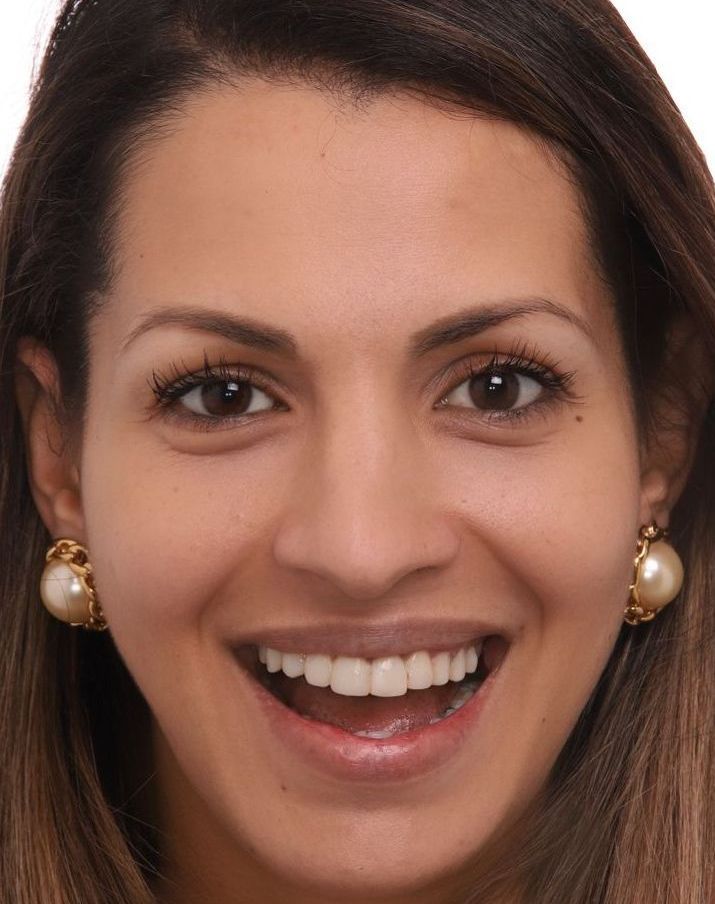 A woman wearing pearl earrings is smiling with her mouth open