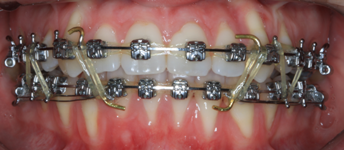 ortodonzia fissa