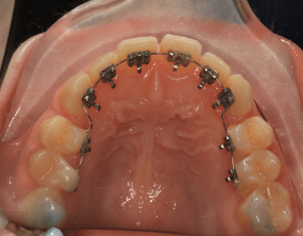 ortodonzia linguale