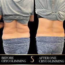 Sculpt and slim your body with Cryoslimming at Struktur Studio Calgary, a non-invasive treatment.