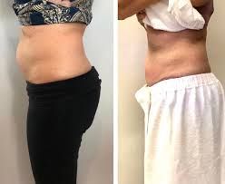 collagen loss