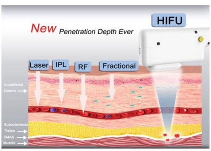 HIFU Penetration Depth