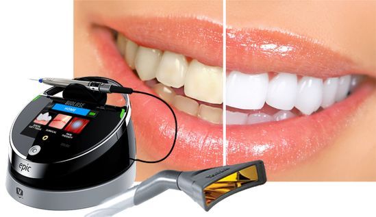 Dantų balinimas kapomis ir lazeriu