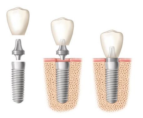 Dantų implantavimas (dantų implantai)