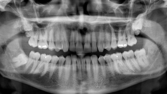 3D skaitmeninės rentgeno ir panoraminės dantų nuotraukos