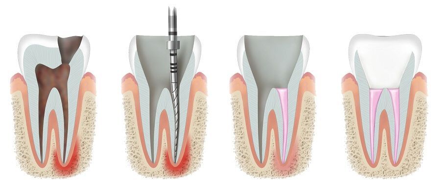 Dantų šaknų kanalų gydymas mikroskopu (endodontija)
