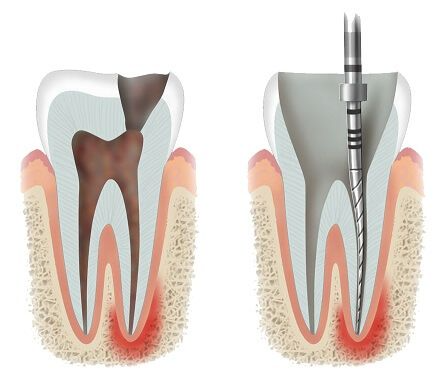 Dantų šaknų kanalų gydymas mikroskopu