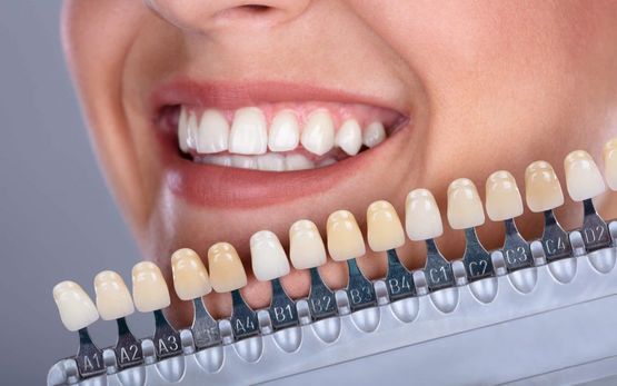 Estetinis dantų plombavimas