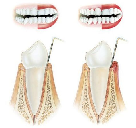 Periodontologinis gydymas