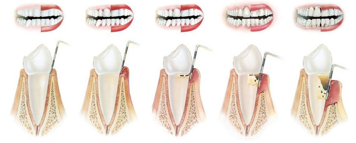 Periodontologinis gydymas (periodontologai)