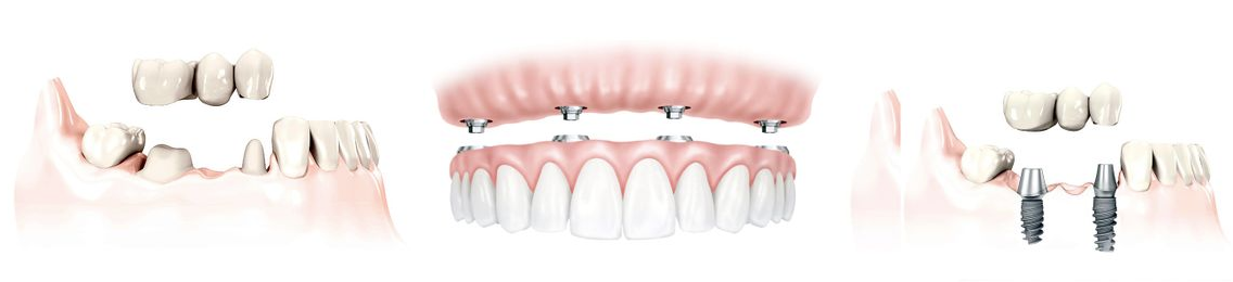 Dantų protezavimas (dantų protezai)