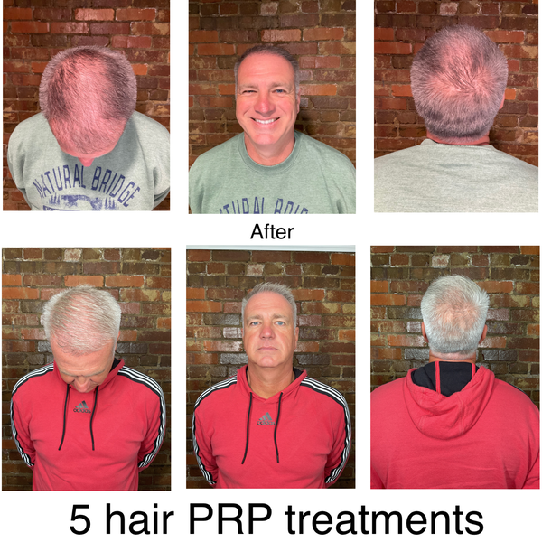 PRP Hair Before and After at Lush Aesthetics