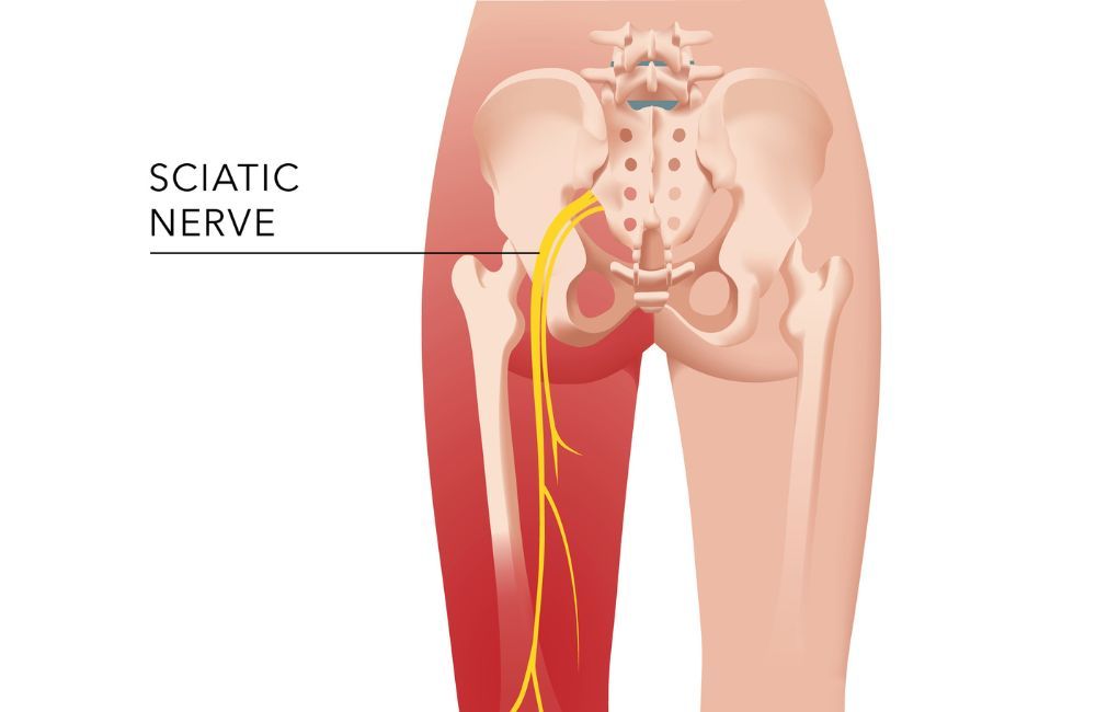 Massage Therapy for Sciatica