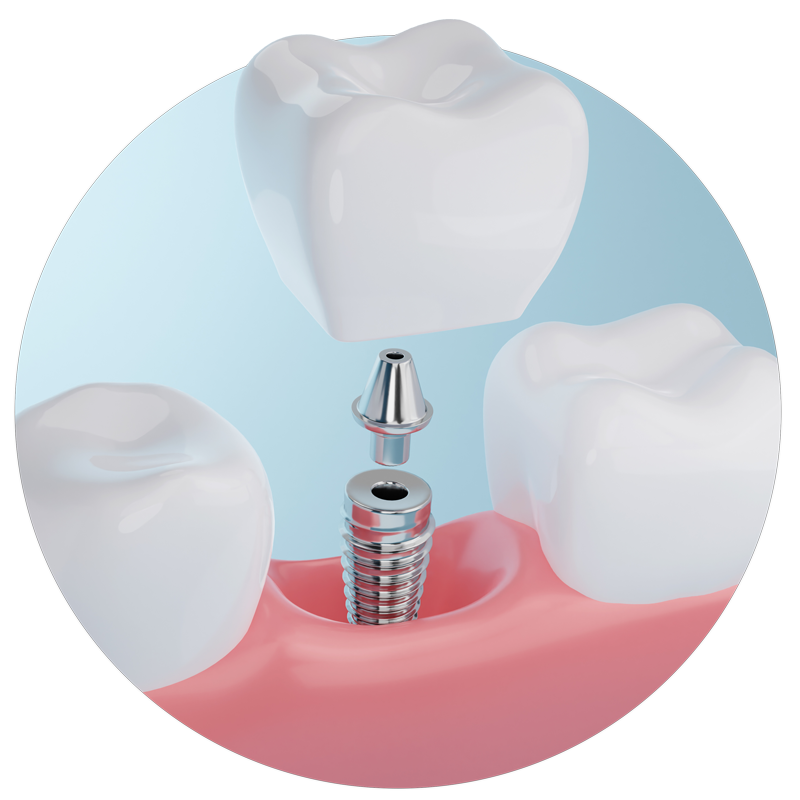 Dental Implant — Spartanburg, SC – Janulis Dental Lab Inc