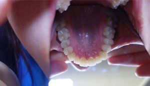 Mouth wide open, teeth wide apart, with picture taken from below to show the upper teeth.