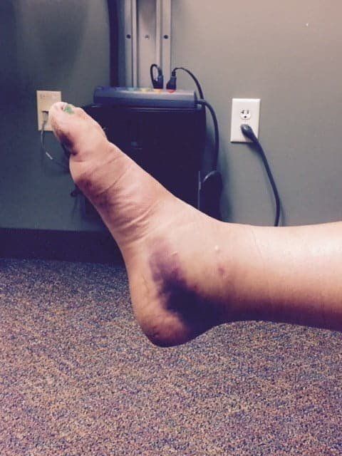Swollen foot and ankle, deep purple bruising, indoors, next to a wall with outlets.