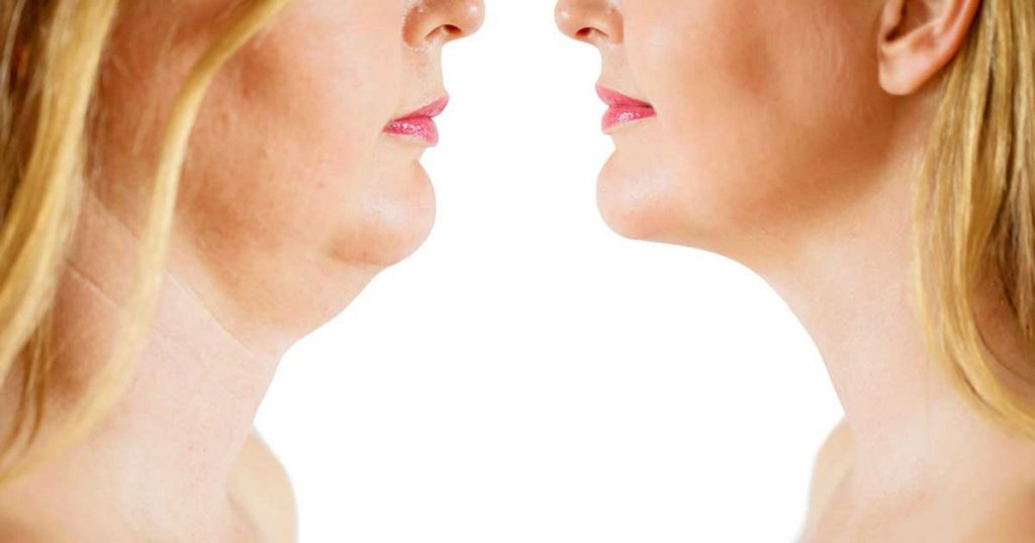 Permanent Fat reduction