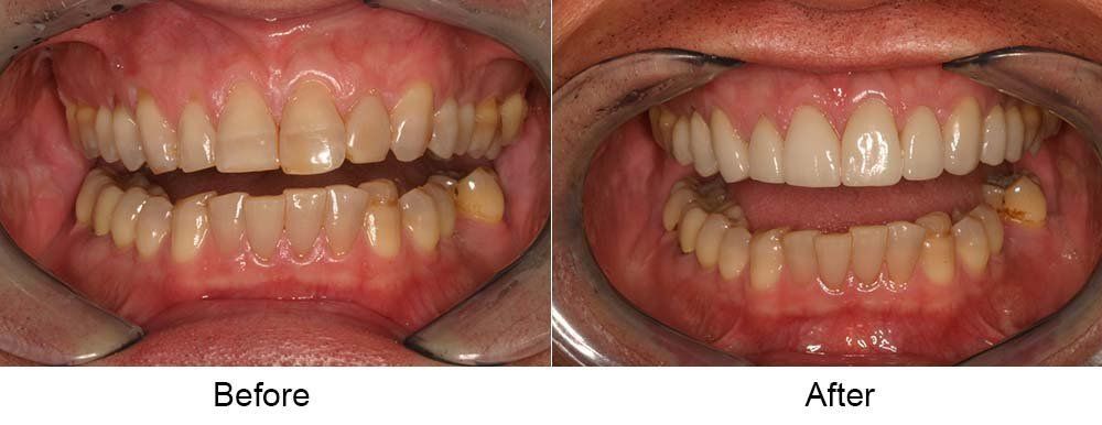 Before and After Images of Teeth Cleaning — Indianapolis, IN — Hollander, Jay A