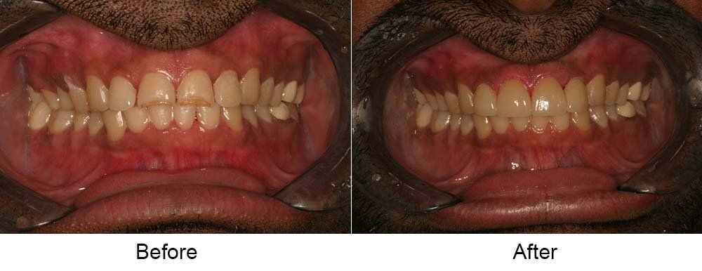 Two Front Teeth Restoration — Indianapolis, IN — Hollander, Jay A