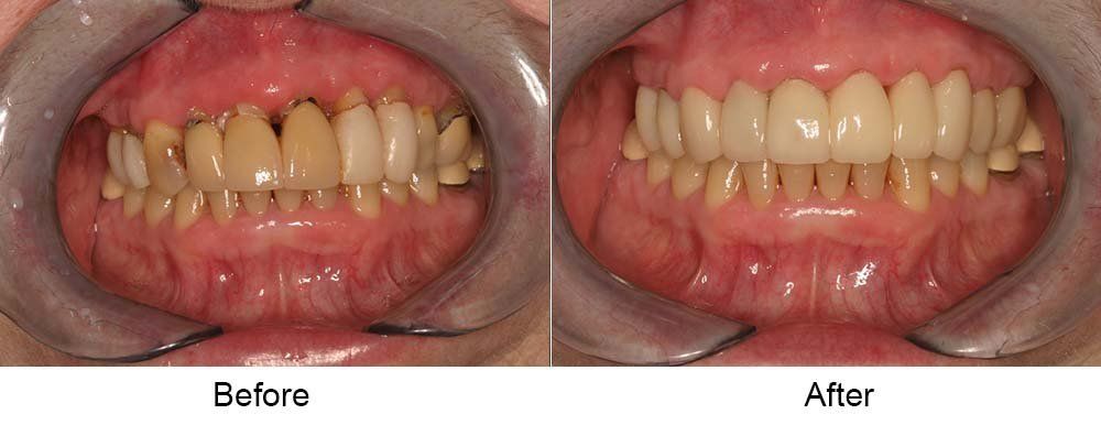 Before and After Dental Filings — Indianapolis, IN — Hollander, Jay A