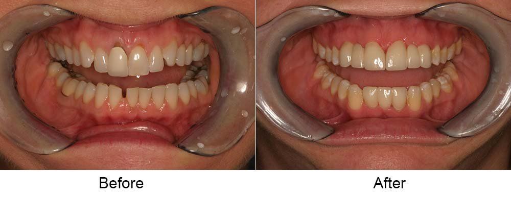 Before and After Cosmetic Dental Work — Indianapolis, IN — Hollander, Jay A
