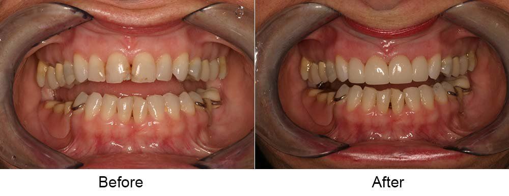 Before and After Dental Crowns — Indianapolis, IN — Hollander, Jay A
