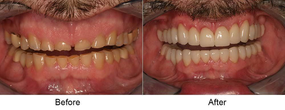 Before and After Cosmetic Dental Restoration and Crownings — Indianapolis, IN — Hollander, Jay A