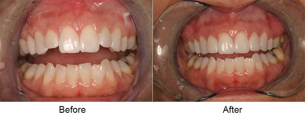 Before and After Laser Dentistry — Indianapolis, IN — Hollander, Jay A