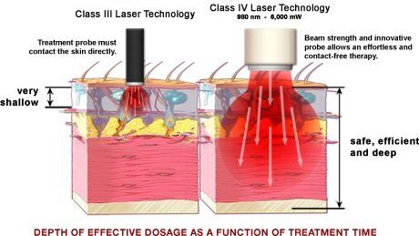 Uitleg Hoe werkt Laser therapie