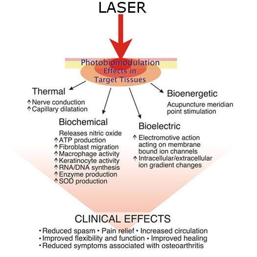 Hoe werkt Laser therapie
