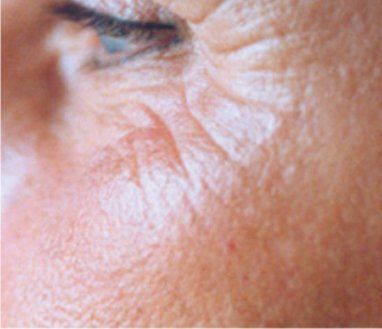 Nahaufnahme des Gesichts einer Person mit Fältchen um die Augen und auf der Wange und sichtbarer Hautstruktur.