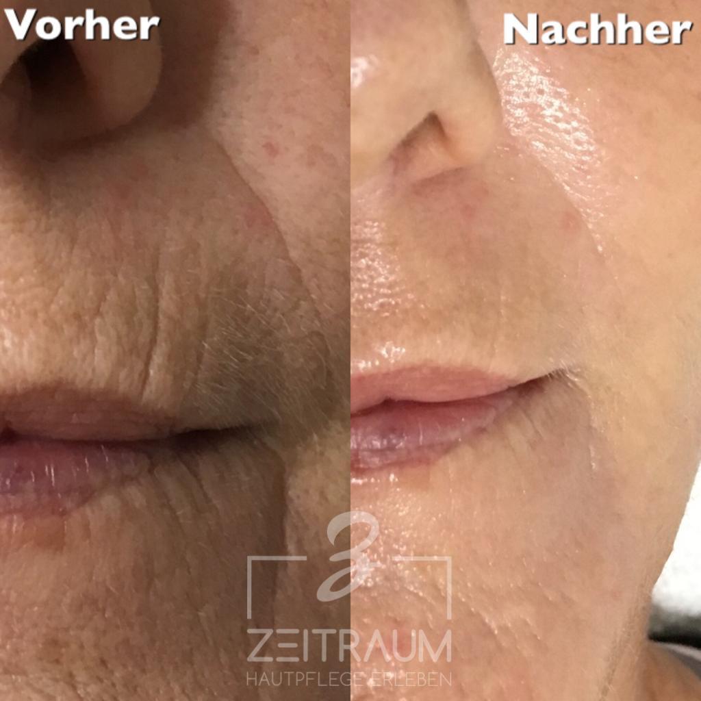 Vergleich des Gesichts einer Person vor und nach einem kosmetischen Eingriff. Auf der „Vorher“-Seite sind sichtbare Falten um den Mund herum zu sehen, während auf der „Nachher“-Seite eine glattere Haut zu sehen ist.