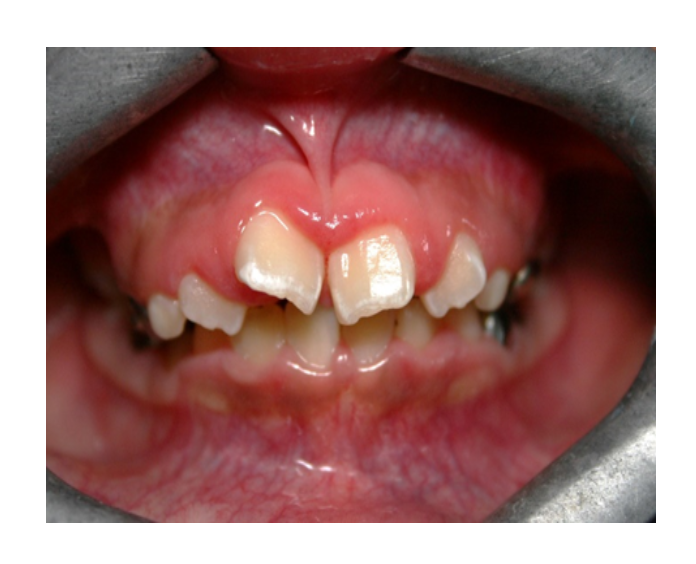 Clase I Protrusión dental