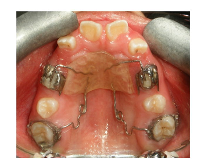 Clase I Protrusión dental