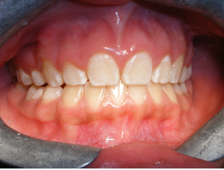 Clase I Protrusión dental