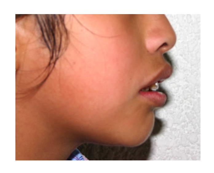 Clase I Protrusión dental