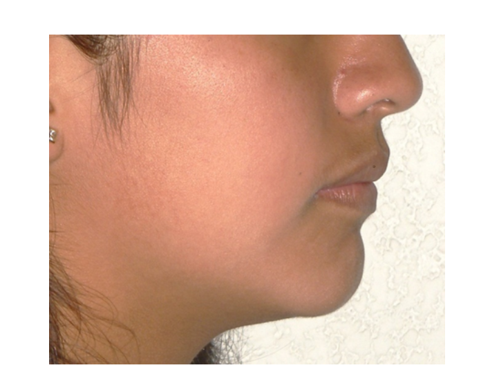 Clase I Protrusión dental