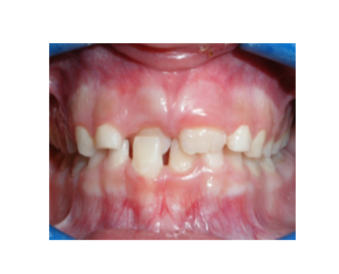 Mordida Cruzada anterior unidental