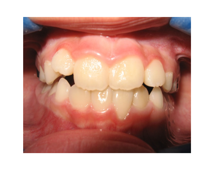 Mordida Cruzada anterior unidental