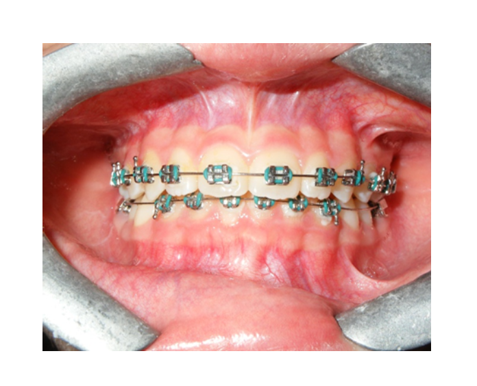 Mordida Cruzada anterior unidental