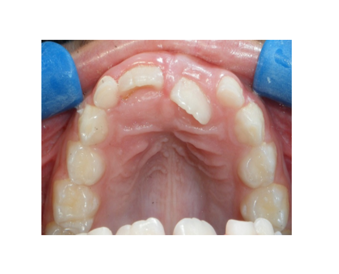 Mordida Cruzada anterior unidental