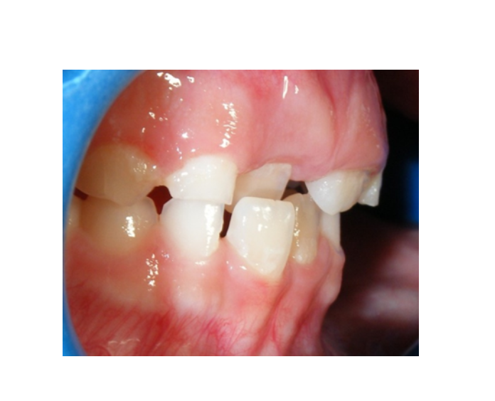 Mordida Cruzada anterior unidental