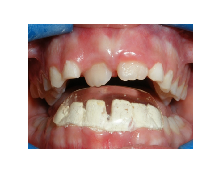 Mordida Cruzada anterior unidental