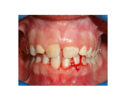 Mordida Cruzada anterior unidental