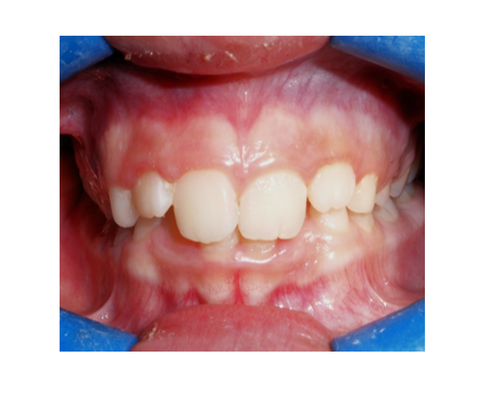Mordida Cruzada anterior unidental