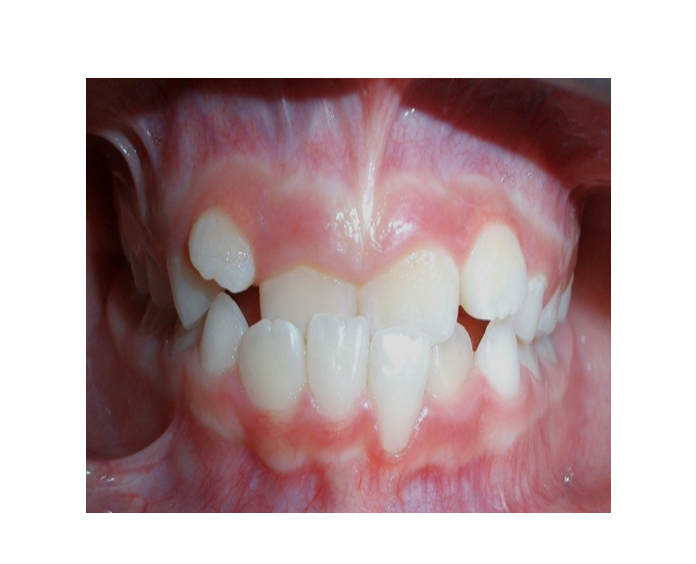 Mordida Cruzada anterior unidental
