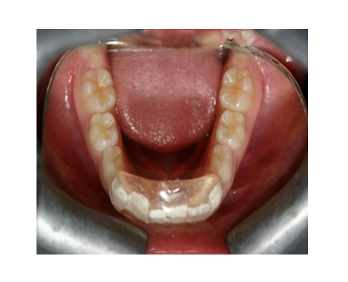 Mordida Cruzada anterior unidental