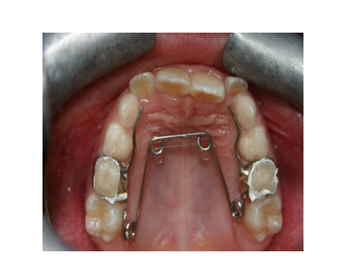 Mordida Cruzada anterior unidental