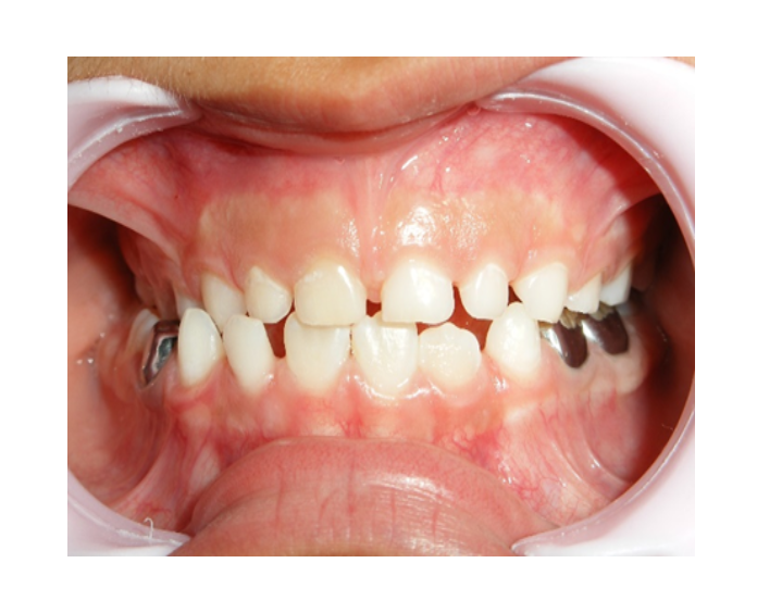 Mordida Cruzada posterior unilateral