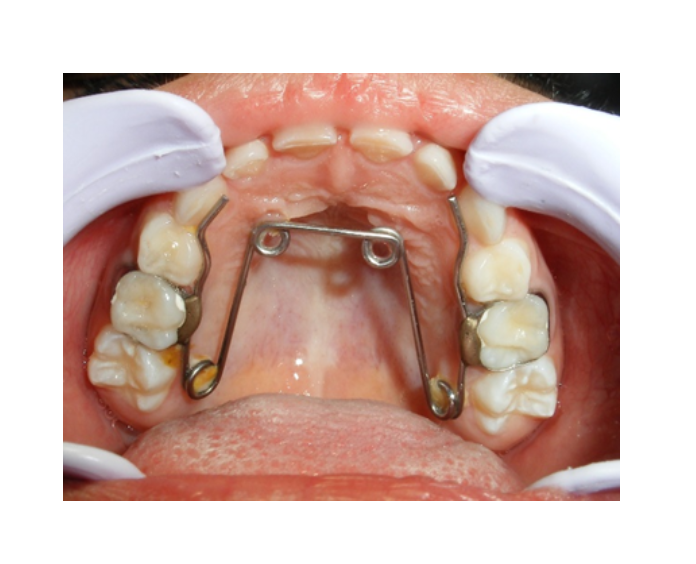 Mordida Cruzada posterior unilateral